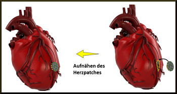 Towards entry "Development of a dual layer, conductive, biomimetic polymer scaffold for cardiac tissue engineering"